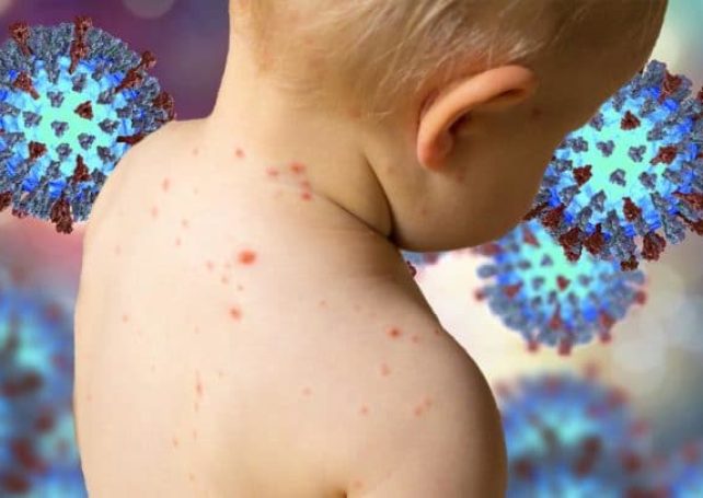 Measles won’t be prevalent: govt