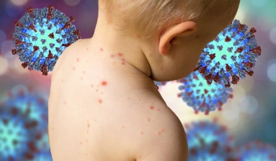 Measles won’t be prevalent: govt