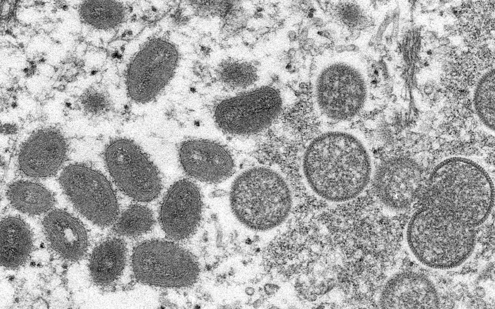 Residents warned again about virulent monkeypox disease