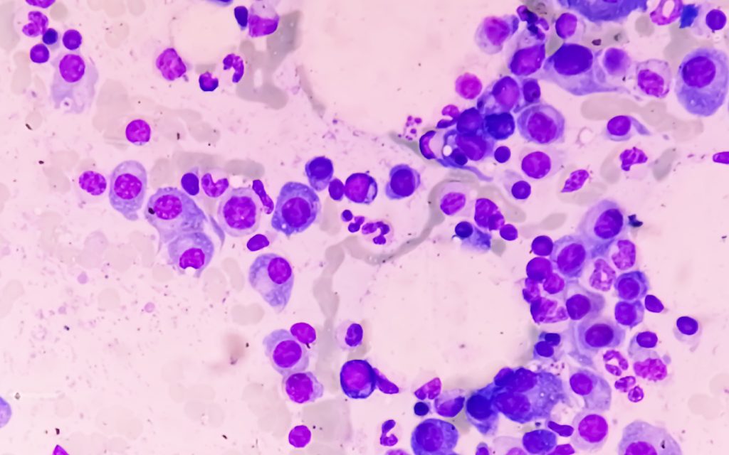 A bone marrow microscope slide showing myeloma. Recent advances in drugs have greatly improved the prognosis for the disease